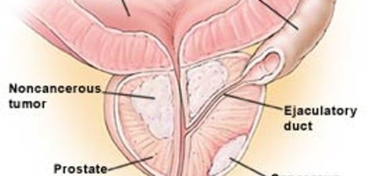 Sabato e domenica a Siracusa meeting sulle nuove ricerche sul trattamento della neoplasia vescicale
